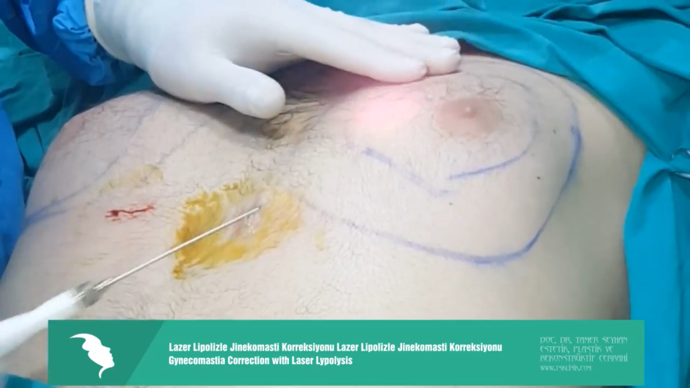  Gynecomastia Correction with Laser Lipolysis