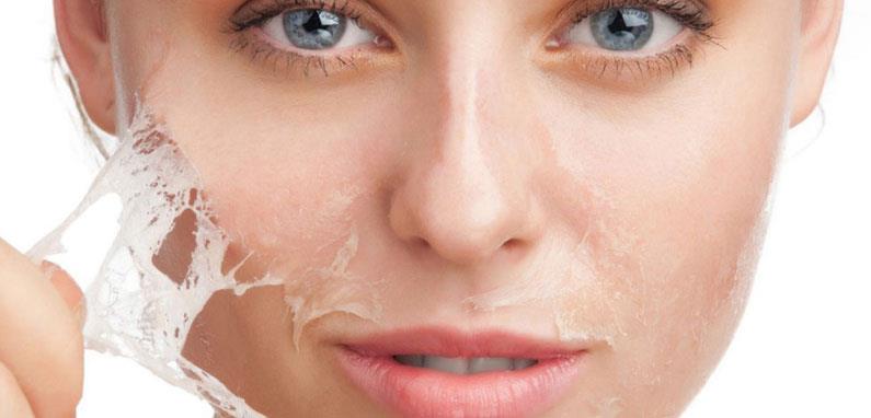 Chemical Peeling